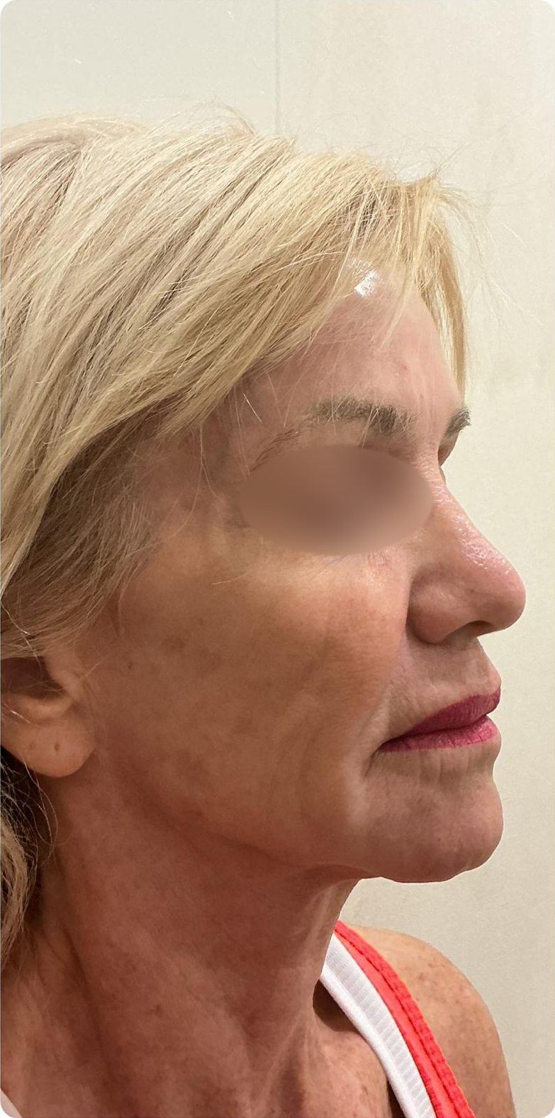 Face profile — after 4 XERF treatments — after