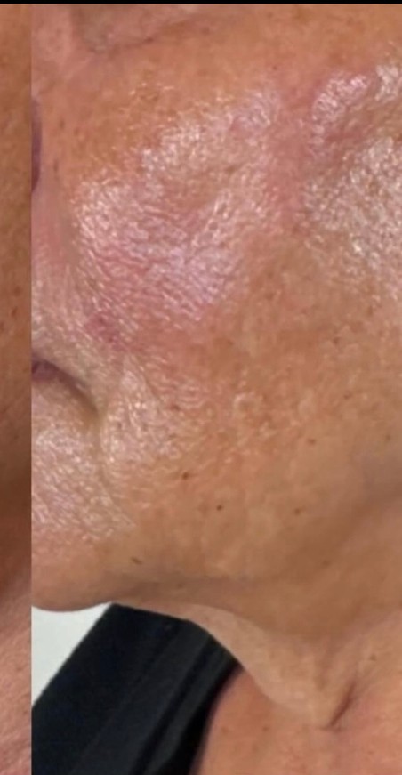 Cheek & skin texture — after 4 XERF treatments — after