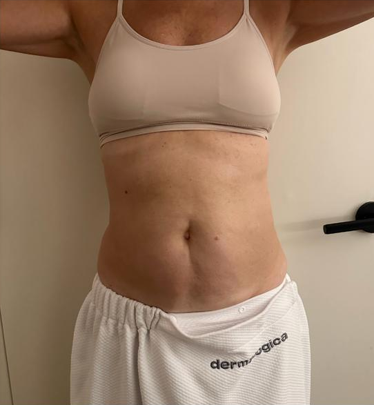 Supplied LipoMax abdomen photos. Individual results vary. — after