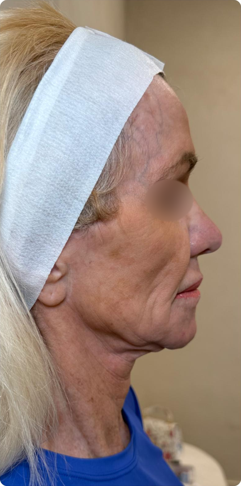 Face profile — after 4 XERF treatments — before