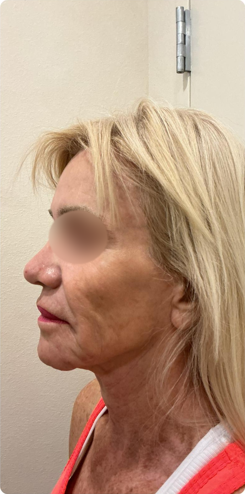 Opposite profile — after 4 XERF treatments — after