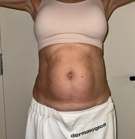 Supplied LipoMax abdomen photos. Individual results vary. — before