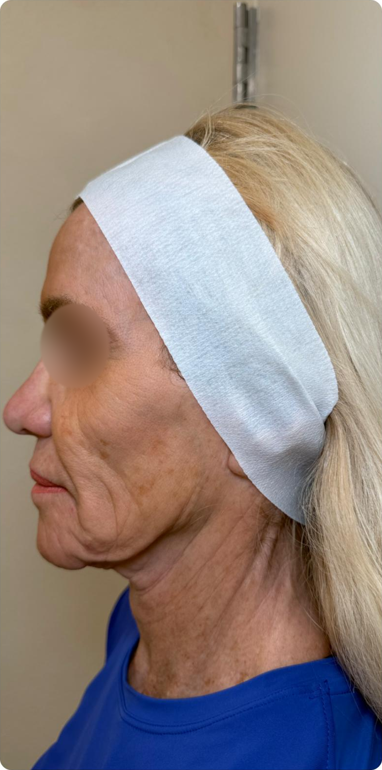 Opposite profile — after 4 XERF treatments — before