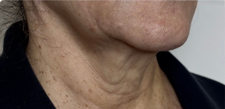 Neck & jawline — after 3 XERF treatments — before