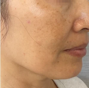 After 1 Ultra treatment — before