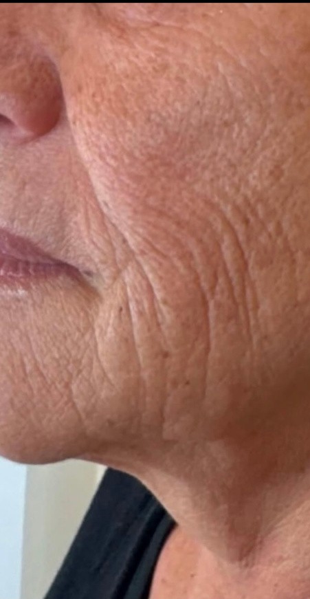 Cheek & skin texture — after 4 XERF treatments — before